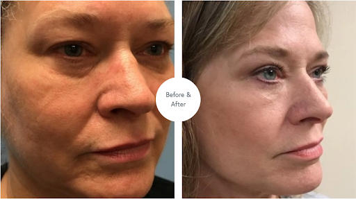 Cellenis Derma PRP